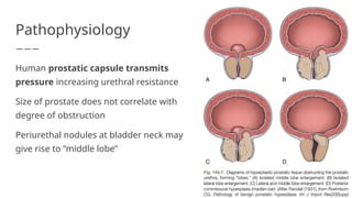 Obstructed Prostate BPH_ Etiology, Pathophysiology, Epidemiology, and Natural History | PPTX