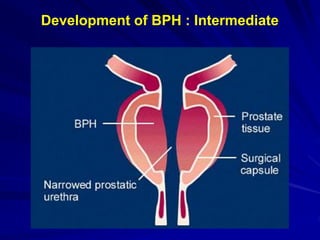 Benign prostatic hyperplasia by Sayed Eleweedy | PPT