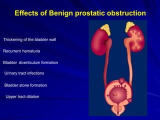 Renal damage
Renal damage from obstructive
uropathy due to BOO (bladder outlet
obstruction) is a feared complication
It ca...