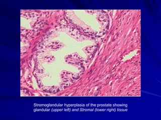 Benign Prostatic Hyperplasia
Etiologic Theories
Aging, perhaps through vascular mechanisms, leads to further
alteration in...