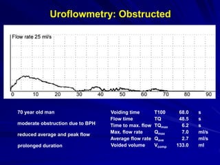 :Uroflowmetry Urethral stricture
Voiding time T100 117.0 s
Flow time TQ 115.0 s
Time to max. flow TQmax 0.5 s
Max. flow ra...
