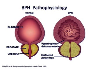 BPH Pathophysiology
Normal BPH
Hypertrophied
detrusor muscle
Obstructed
urinary flow
PROSTATE
BLADDER
URETHRA
Kirby RS et al. Benign prostatic hyperplasia. Health Press, 1995.
 