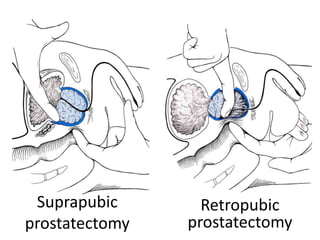 Suprapubic
prostatectomy
Retropubic
prostatectomy
 