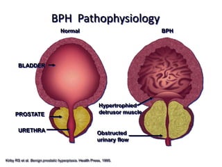 BPH Pathophysiology
Normal BPH
Hypertrophied
detrusor muscle
Obstructed
urinary flow
PROSTATE
BLADDER
URETHRA
Kirby RS et ...