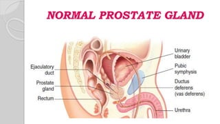 NORMAL PROSTATE GLAND
 