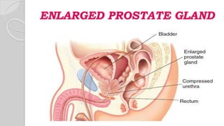 ENLARGED PROSTATE GLAND
 