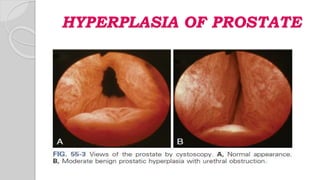 HYPERPLASIA OF PROSTATE
 