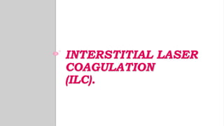 INTERSTITIAL LASER
COAGULATION
(ILC).
 