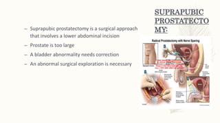 PERINEAL
PROSTATECTOMY:An incision is made into the perineum
between the anus and the scrotum.
This operation is rarely us...