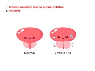 • Irritative symptoms: (due to detrusor irritation):
1. Prostatitis-
 