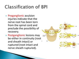  Preganglionic avulsion
injuries indicate that the
nerve root has been torn
from the spinal cord and
preclude the possibility of
recovery.
 Postganglionic lesions may
be either in continuity (root
and sheath intact) or
ruptured (root intact and
nerve sheath ruptured).
 