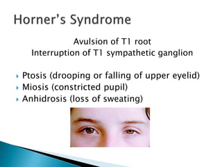 Avulsion of T1 root
Interruption of T1 sympathetic ganglion
 Ptosis (drooping or falling of upper eyelid)
 Miosis (constricted pupil)
 Anhidrosis (loss of sweating)
 