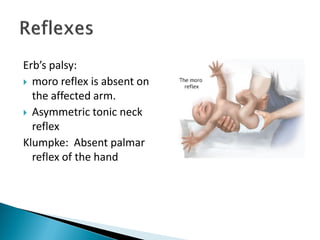 Erb’s palsy:
 moro reflex is absent on
the affected arm.
 Asymmetric tonic neck
reflex
Klumpke: Absent palmar
reflex of the hand
 