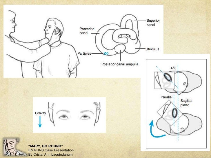 Benign Paroxysmal Positional Vertigo