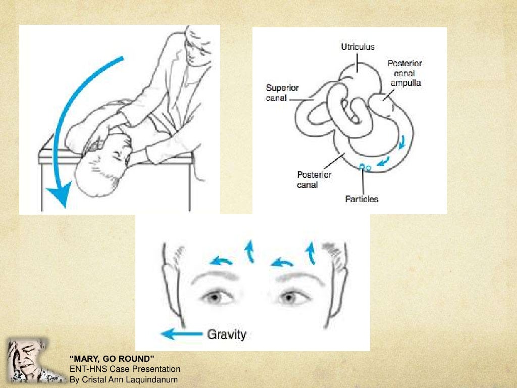 Benign Paroxysmal Positional Vertigo
