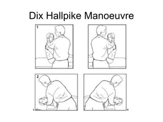 Dix Hallpike Manoeuvre

 