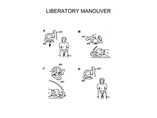 LIBERATORY MANOUVER

 