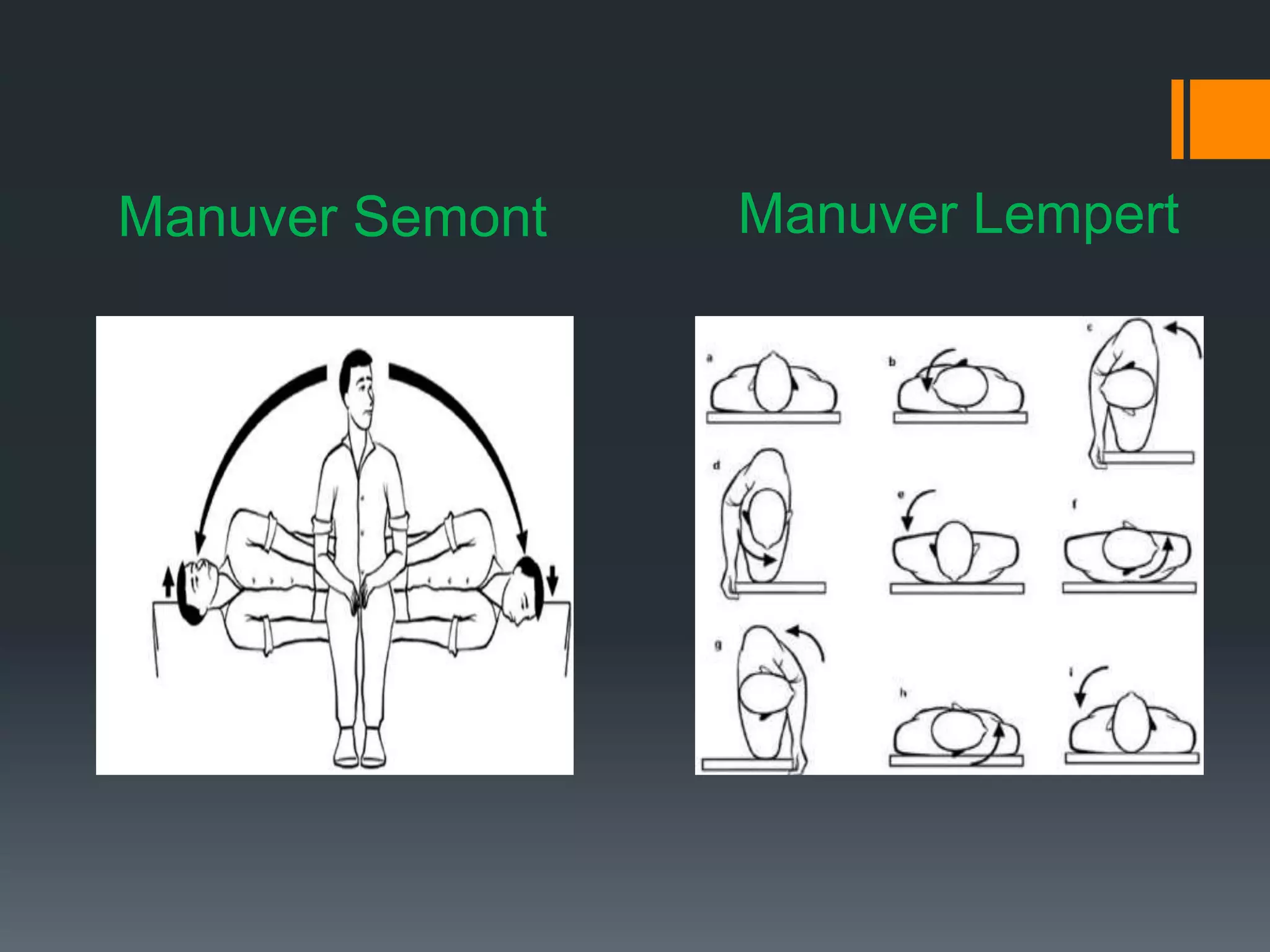 Semont R Bppv Bppv | PPTX