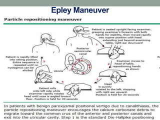 (Epley maneuver)
Epley Maneuver
 