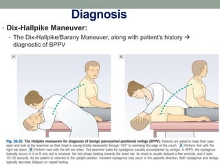 Diagnosis
• Dix-Hallpike Maneuver:
• The Dix-Hallpike/Barany Maneuver, along with patient's history 
diagnostic of BPPV
 