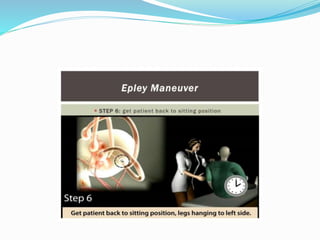 BPPV | PPTX