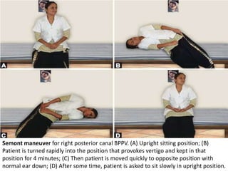 Semont R Bppv Benign paroxysmal positional vertigo.pptx