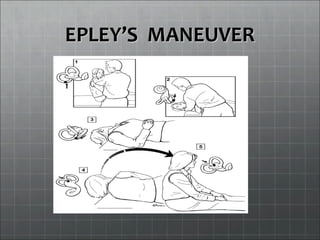 EPLEYEPLEY’S MANEUVER’S MANEUVER
 