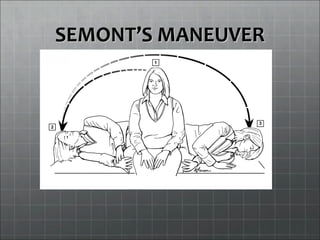 SEMONTSEMONT’S MANEUVER’S MANEUVER
 