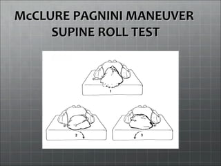 McCLURE PAGNINI MANEUVERMcCLURE PAGNINI MANEUVER
SUPINE ROLL TESTSUPINE ROLL TEST
 