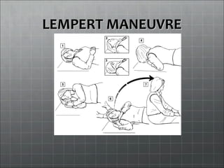 LEMPERT MANEUVRELEMPERT MANEUVRE
 