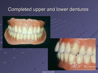 How Dentures are Made - BPS System