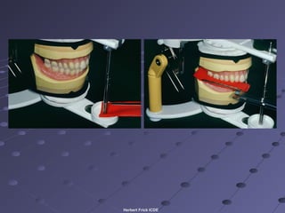 How Dentures are Made - BPS System