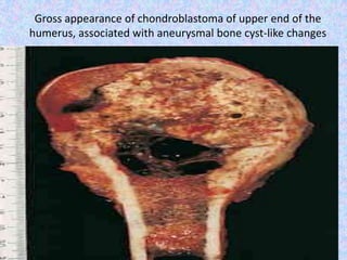 Bone tumours by dr narmada prasad tiwari | PPT