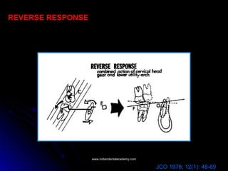REVERSE RESPONSE
JCO 1978; 12(1): 48-69
www.indiandentalacademy.comwww.indiandentalacademy.com
 