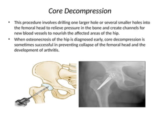 hip joint conditions and physiotherapy management | PPTX