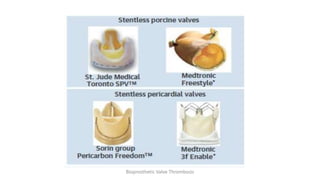 Bioprosthetic Valve Thrombosis
 