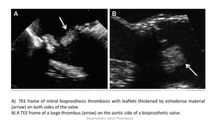 A) TEE frame of mitral bioprosthesis thrombosis with leaflets thickened by echodense material
(arrow) on both sides of the valve
B) A TEE frame of a large thrombus (arrow) on the aortic side of a bioprosthetic valve.
Bioprosthetic Valve Thrombosis
 