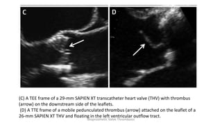 (C) A TEE frame of a 29-mm SAPIEN XT transcatheter heart valve (THV) with thrombus
(arrow) on the downstream side of the leaflets.
(D) A TTE frame of a mobile pedunculated thrombus (arrow) attached on the leaflet of a
26-mm SAPIEN XT THV and floating in the left ventricular outflow tract.
Bioprosthetic Valve Thrombosis
 