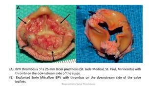 (A) BPV thrombosis of a 25-mm Bicor prosthesis (St. Jude Medical, St. Paul, Minnesota) with
thrombi on the downstream side of the cusps.
(B) Explanted Sorin Mitraflow BPV with thrombus on the downstream side of the valve
leaflets
Bioprosthetic Valve Thrombosis
 