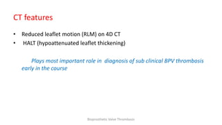 CT features
• Reduced leaflet motion (RLM) on 4D CT
• HALT (hypoattenuated leaflet thickening)
Plays most important role in diagnosis of sub clinical BPV thrombosis
early in the course
Bioprosthetic Valve Thrombosis
 