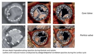 Core Valve
Portico valve
Arrows depict hypoattenuating opacities during diastole and systole.
Leaflets with reduced motion aredepicted by wedge-shaped or semilunar opacities during the cardiac cycleBioprosthetic Valve Thrombosis
 