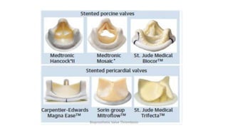 Bioprosthetic Valve Thrombosis
 