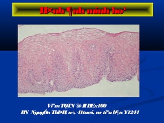 ViªmTQTN ®éIIHEx100
BN NguyÔnThÞH, n÷, 41tuæi, m· tiªub¶nY1244
H×nh ¶nh minh ho¹H×nh ¶nh minh ho¹
 