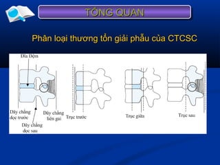 TỔNG QUANTỔNG QUANTỔNG QUANTỔNG QUAN
Phân loại thương tổn giải phẫu của CTCSCPhân loại thương tổn giải phẫu của CTCSC
 