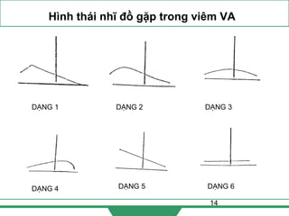 14
Hình thái nhĩ đồ gặp trong viêm VA
DẠNG 1
DẠNG 4
DẠNG 2 DẠNG 3
DẠNG 6DẠNG 5
 