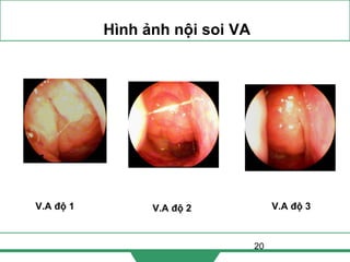 20
Hình ảnh nội soi VA
V.A độ 1 V.A độ 3V.A độ 2
 
