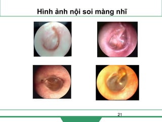 21
Hình ảnh nội soi màng nhĩ
 