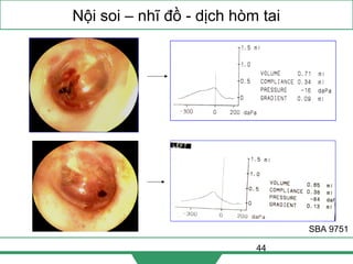 44
Nội soi – nhĩ đồ - dịch hòm tai
SBA 9751
 