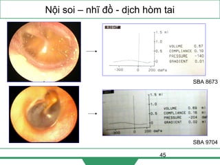 45
Nội soi – nhĩ đồ - dịch hòm tai
SBA 9704
SBA 8673
 