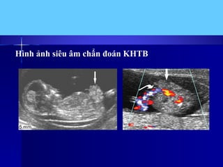 Hình ảnh siêu âm chẩn đoán KHTB
 